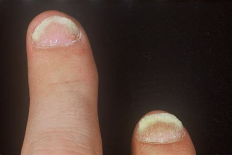 Onycholysis (Psoriatic Arthritis of Nails) – RheumExam Atlas