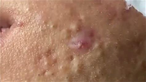 Unbelievable Blackhead Removal 2024: The Ultimate Guide for Clear Skin - c3yb6c7