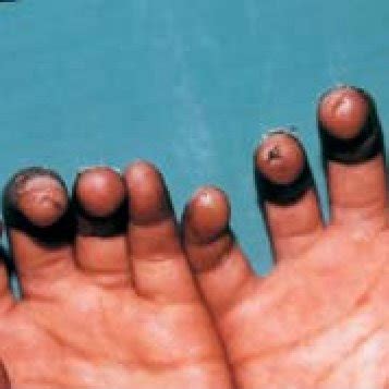 Sclerodactyly, thin lips and flattend lines of expression in case 1 ...
