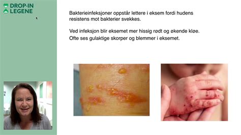 atopisk eksem youtube
