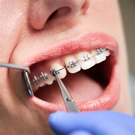 teeth move faster  braces  nancy green blog