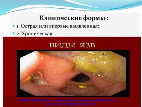 Язвенная болезнь желудка и двенадцатиперстной кишки - презентация онлайн