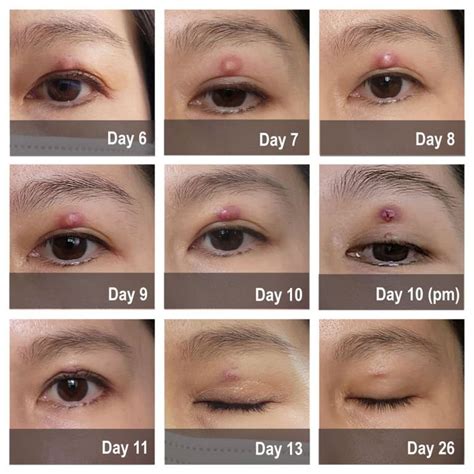 What a "memorable" eye stye recovery experience (includes tips to speed ...