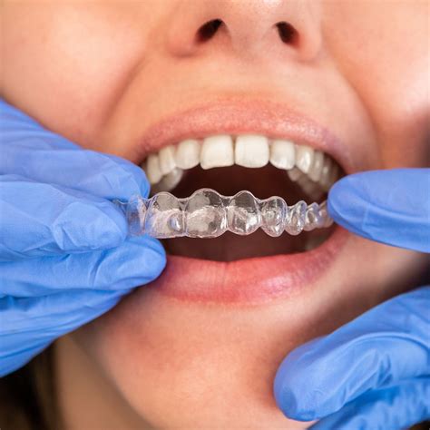 Is Invisalign Near Me a Good Option for Straightening Teeth?