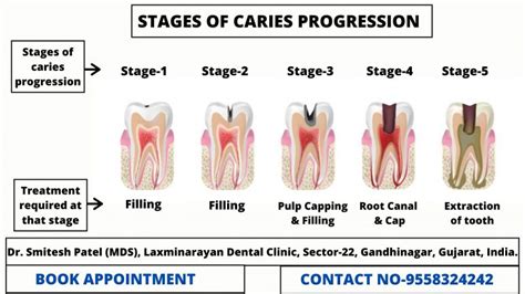 Tooth Decay Stages and How to Treat Each? - Laxmi Narayan ...