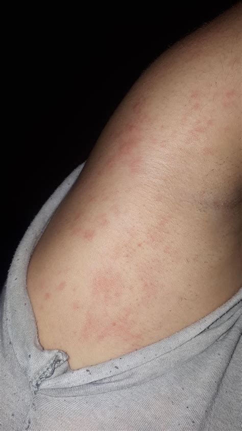 Nesselsucht? Allergie? Röteln? Was hilft? (Gesundheit und Medizin