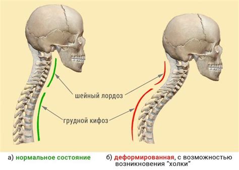 Лордоз шейного отдела позвоночника: лечение и симптомы, что значит ...