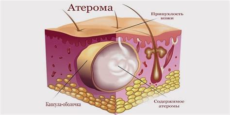 Удаление атером - причины образования и лечение