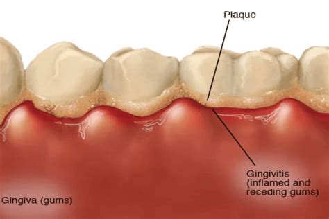 symptoms treatment  prevention  gingivitis dental depot