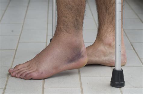 Four Sprained Ankle Symptoms — Dr. Elton