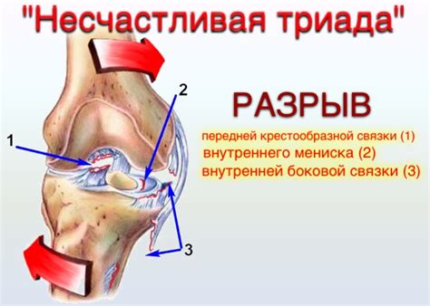 Причины и симптомы разрыва крестообразной связки коленного сустава ...
