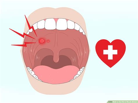 Blood Blisters Inside Of Lip - Infoupdate.org