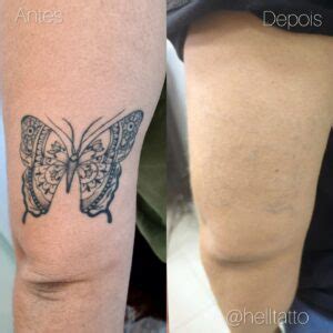 Tatuagem Tem Como Tirar - Remoção de tatuagem: como tirar tatuagem e cuidados