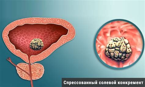 Камни В Мочевом Пузыре Фото — Mixyfotos.ru