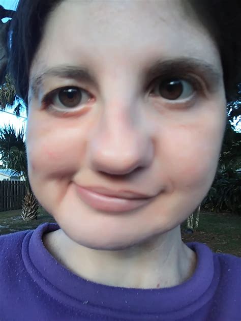 CHARGE Syndrome | Signs, Symptoms, Support