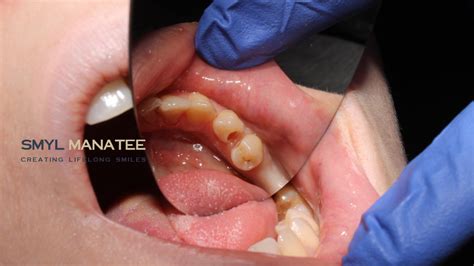 Front Tooth Cavity Filling: Procedure, Cost, and Best Care Practices