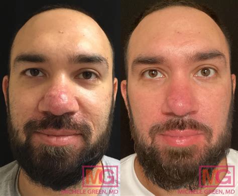 Accutane Before and After: Transformative Results and Essential Tips ...