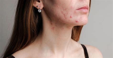 Hormonal vs Bacterial Acne: How to tell the difference | Clinikally