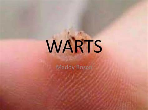 Warts | PPTX