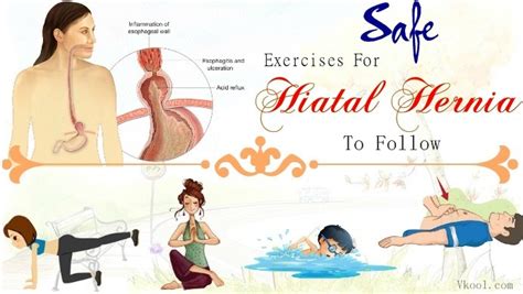 16 Safe Exercises For Hiatal Hernia To Follow