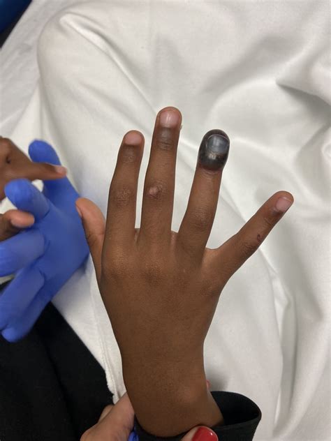 Pediatric Subungual Hematoma and Nail Bed Laceration - Best Wound Practice