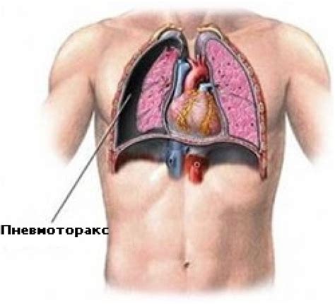 Пневмоторакс - признаки, причины, симптомы, лечение и профилактика ...
