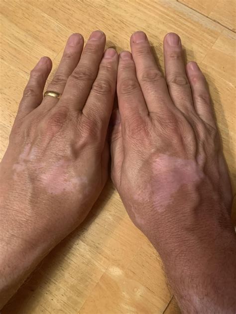 Opzelura for the hands : r/Vitiligo