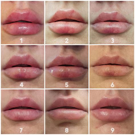 lip filler swelling timeline  long