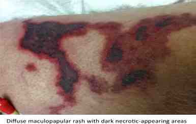 Image of skin findings: diffuse maculopapular rash with dark