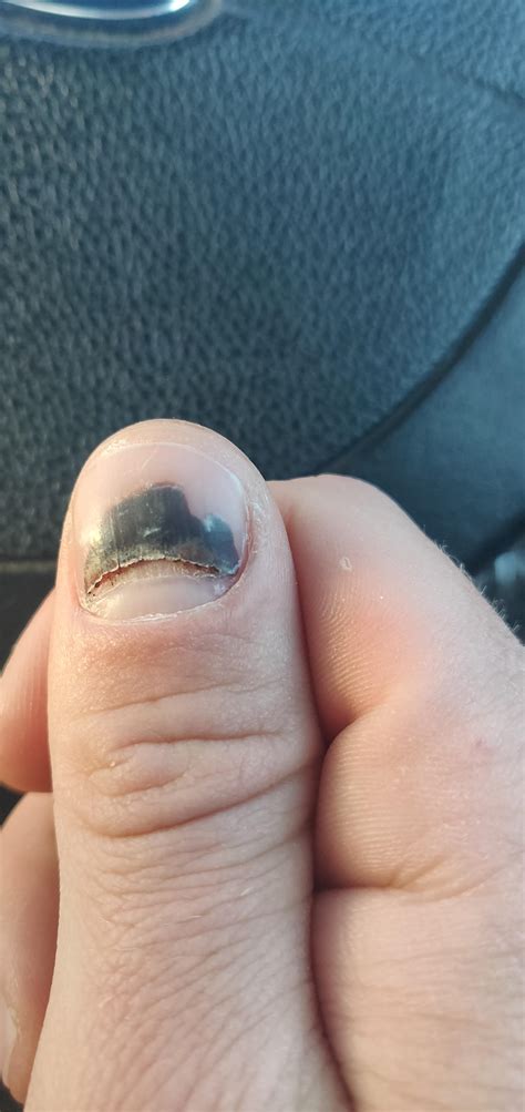 Subungual Hematoma Treatment Nhs at Helen Williamson blog