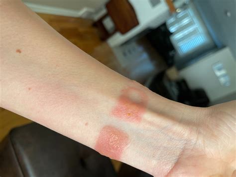 Has anyone gotten a burn from the newest … - Apple Community