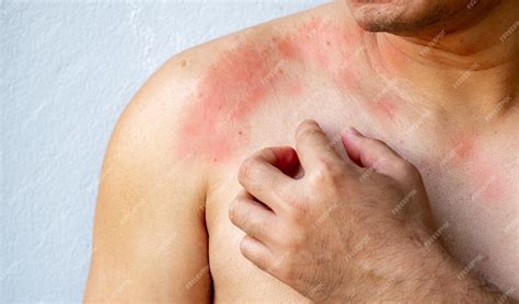 Corpo Coçando O Que Pode Ser - Close up Mão de um homem coçando com coceira na pele no corpo no peito ...