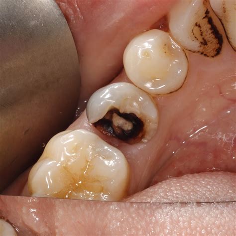 The lower right first premolar with a very large deep cavity was ...