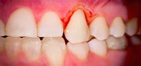 5 Alarming Signs You Have A Mouth Infection Brewing