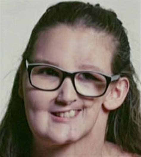 Parry-Romberg syndrome by SteveH51 on DeviantArt