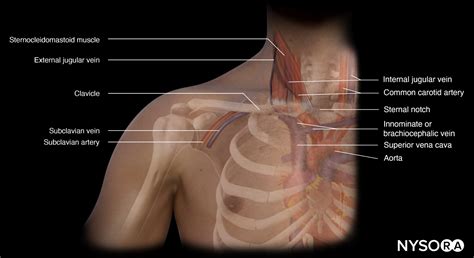 tips  subclavian vein cannulation nysora
