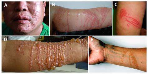 Box Jelly Fish Sting