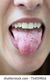 how to fix cracked tongue