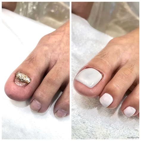 Nail Reconstruction Treatment | Nails by Toe Bro