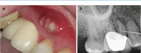 sinus tract  guidebook  molar endodontics