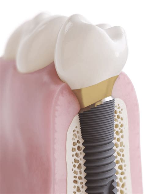 OsseoSpeed Profile EV (ASTRA TECH Implant System) - Dentsply Sirona ...