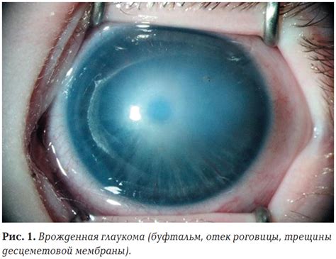 Рис. 1. Врожденная глаукома (буфтальм, отек роговицы, трещины десцемет…