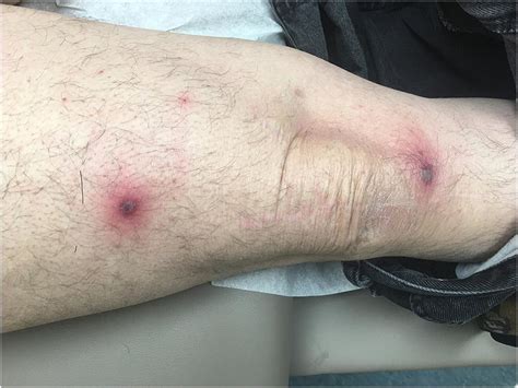 Two characteristic eschars of African tick-bite fever in the leg of a ...