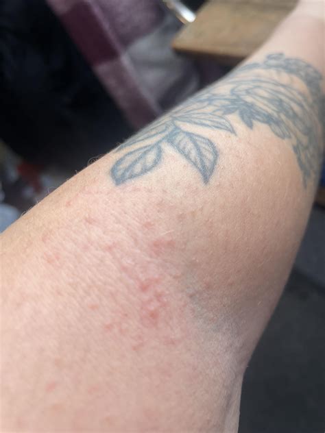 Are these hives? : r/urticaria