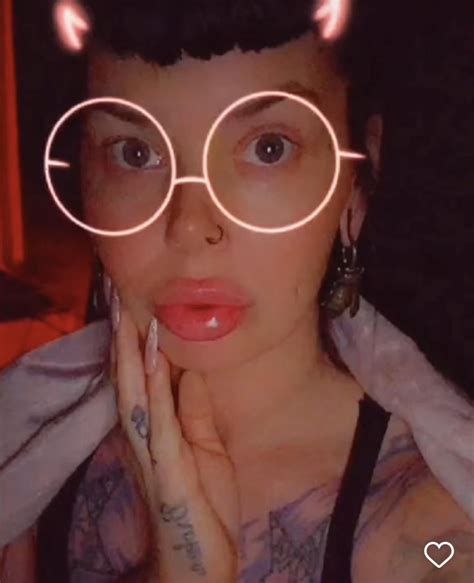 Terrible filler mustache caught on ig : r/Botchedsurgeries