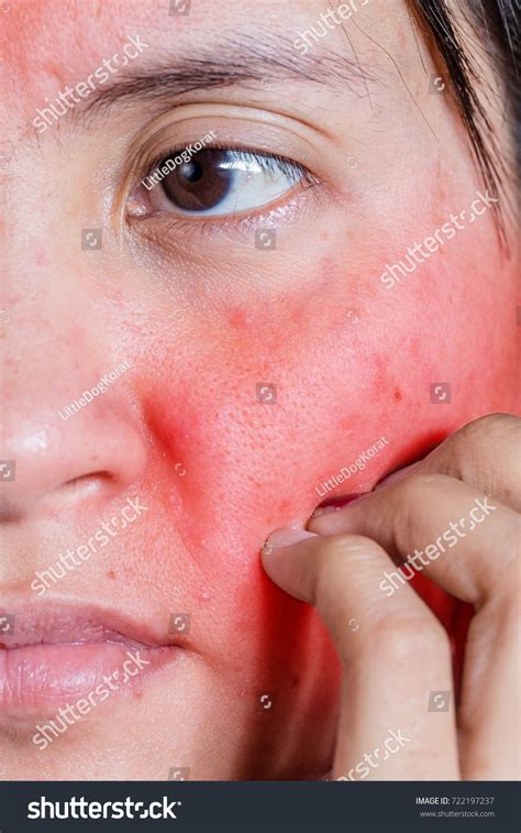 Face Young Woman Itching Red Rash Stock Photo 722197237 | Shutterstock