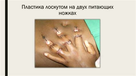 Способы пластического замещения дефектов кожи - online presentation