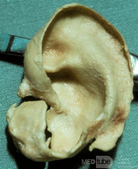 The Auricular Cartilage • Image • MEDtube.net