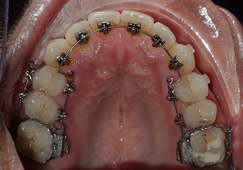 Orthodontic Success Stories