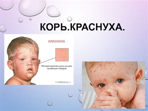 Корь.Краснуха презентация, доклад, проект